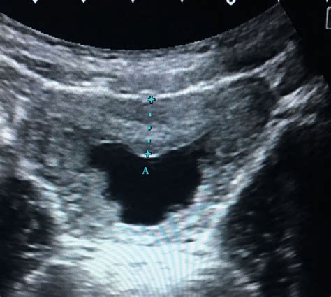 thickened bladder wall measurement ultrasound